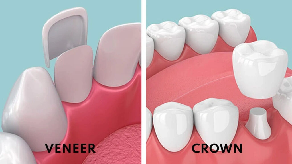 crowns and veneers